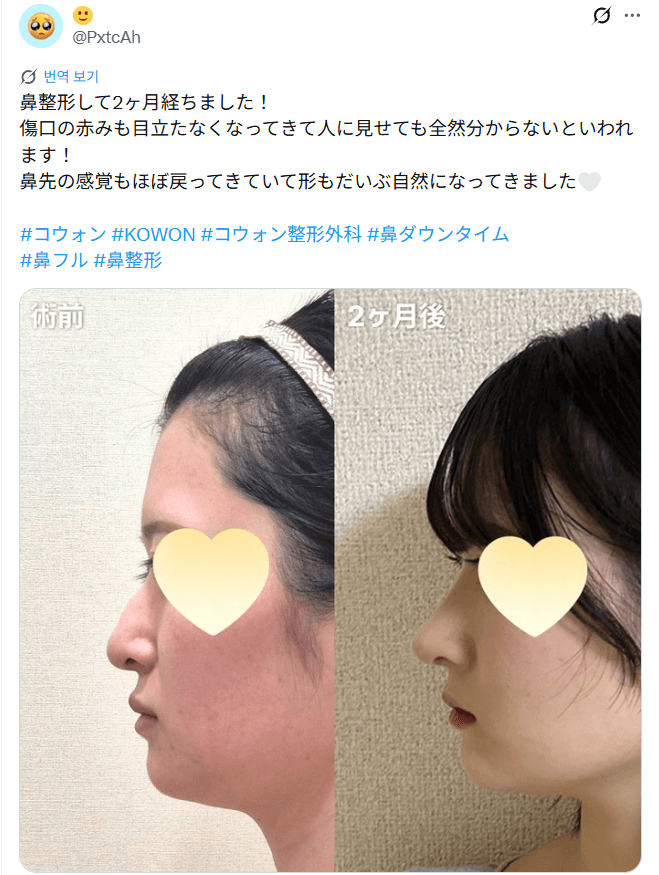 환자수술후기 — 「傷口の赤みも目立たなくなってきた」鼻整形2ヶ月