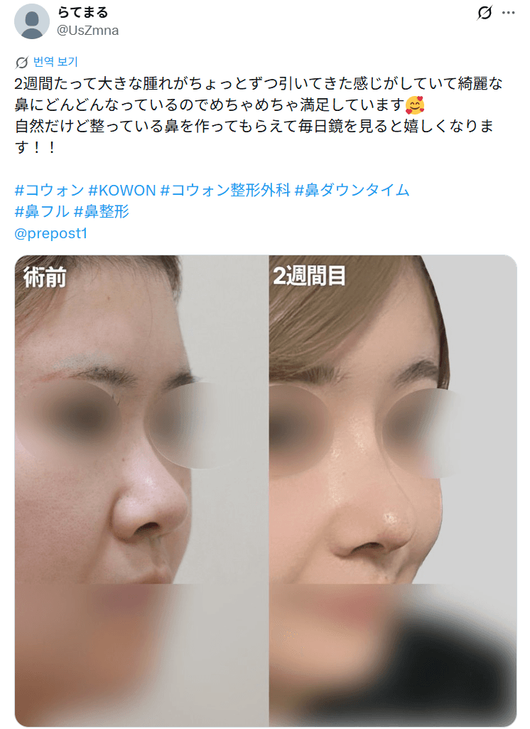 환자수술후기 — 「大きな腫れが少しずつ引いて綺麗な鼻に」鼻整形2週間