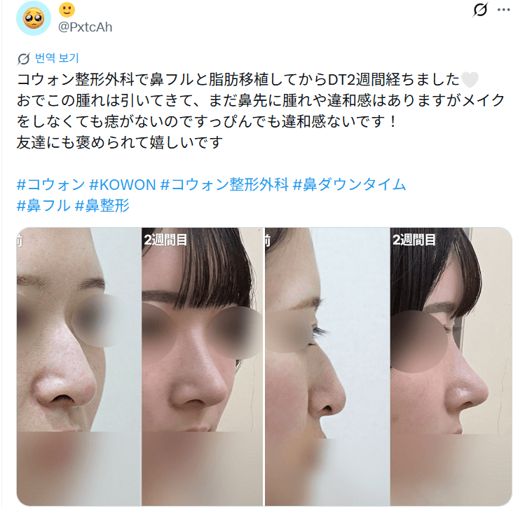 환자수술후기 — 「メイクをしなくても横から見て自然」鼻整形2週間