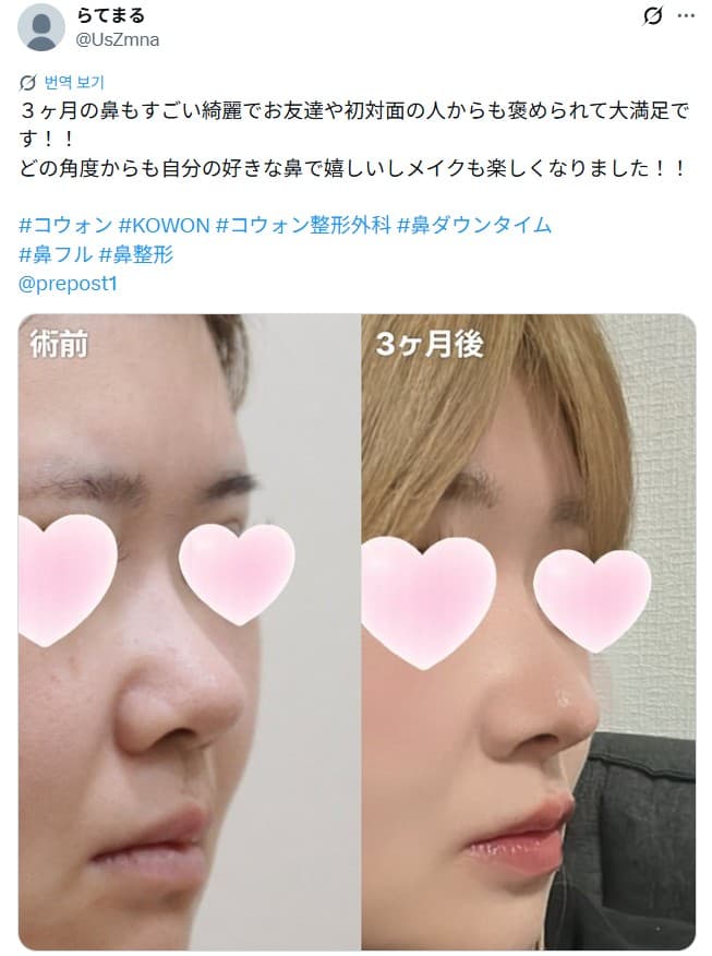 환자수술후기 — 「どの角度からも自分の好きな鼻で嬉しい」鼻整形3ヶ月