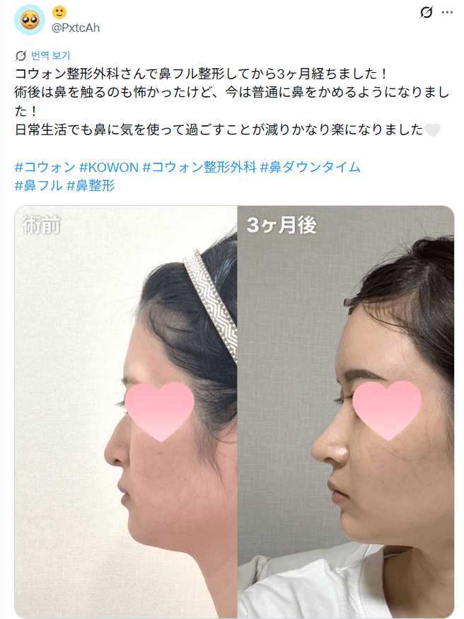 환자수술후기 — 鼻フル整形から3ヶ月。日常生活も楽になった経過