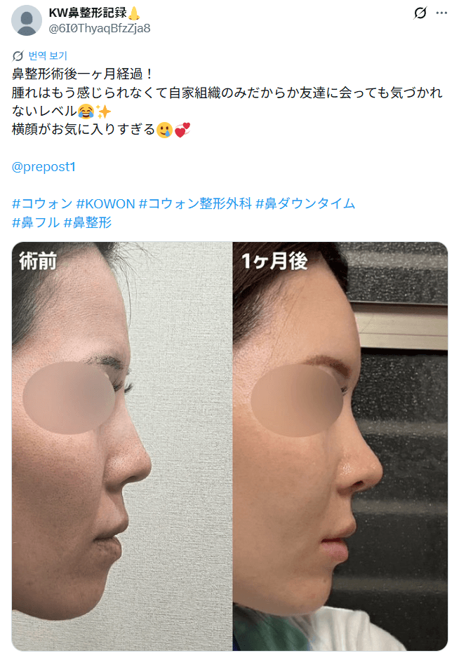 환자수술후기 — 「横顔が気に入りすぎる」鼻整形1ヶ月