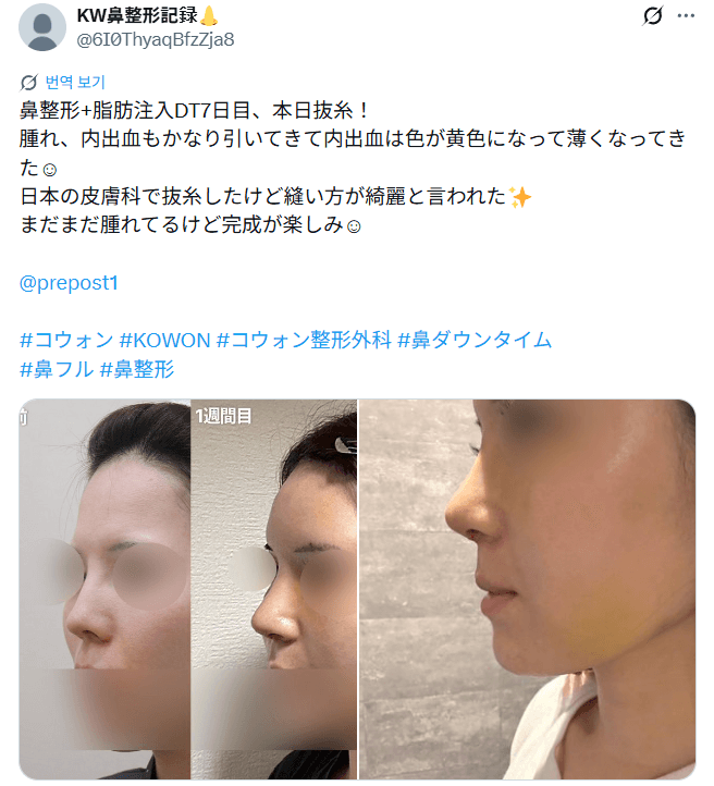 รีวิวหลังผ่าตัดของผู้ป่วย — 「違う方が綺麗と言われた」鼻整形1週間