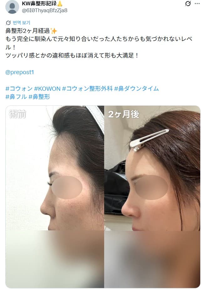 รีวิวหลังผ่าตัดของผู้ป่วย — 「元々知り合いだった人たちからも気づかれないレベル」鼻整形2ヶ月
