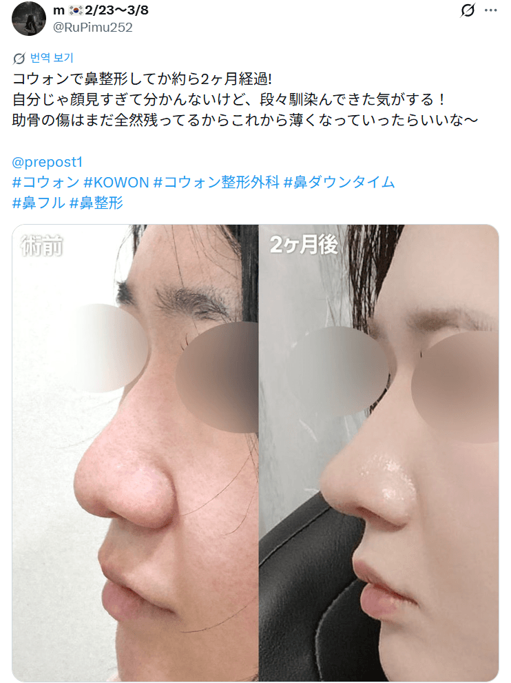 รีวิวหลังผ่าตัดของผู้ป่วย — 「自分じゃ顔見すぎて分からないけど段々馴染んできた」鼻整形2ヶ月