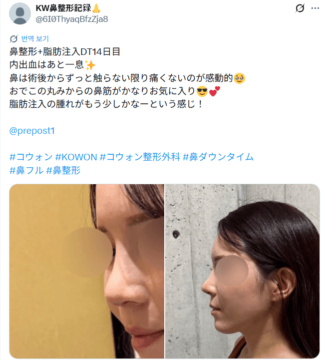 รีวิวหลังผ่าตัดของผู้ป่วย — 「おでこの丸みからの鼻筋がかなりお気に入り」鼻整形2週間