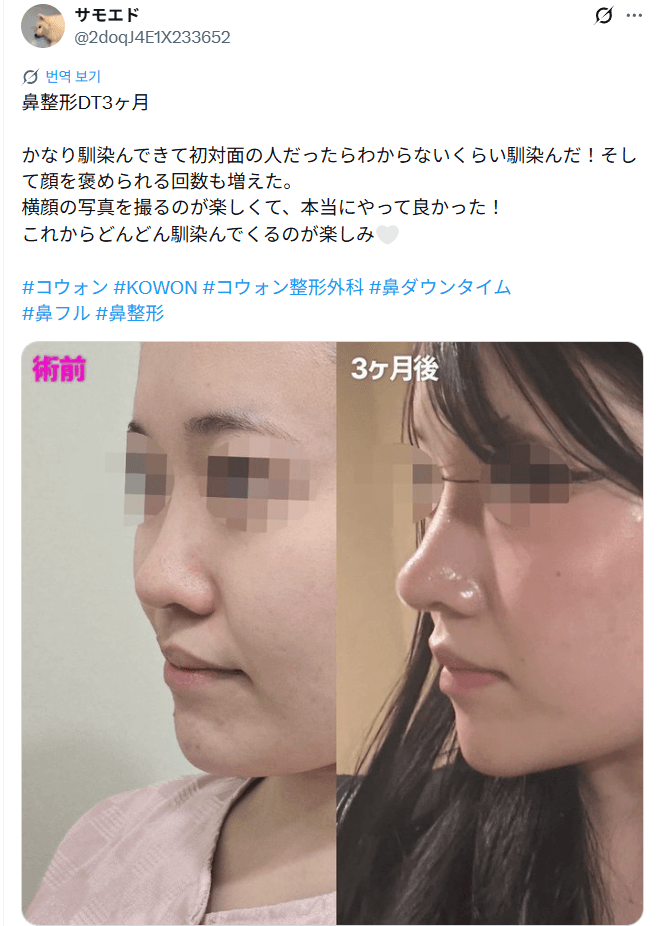 환자수술후기 — 「初対面の人だったらわからないくらい馴染んだ」鼻整形3ヶ月