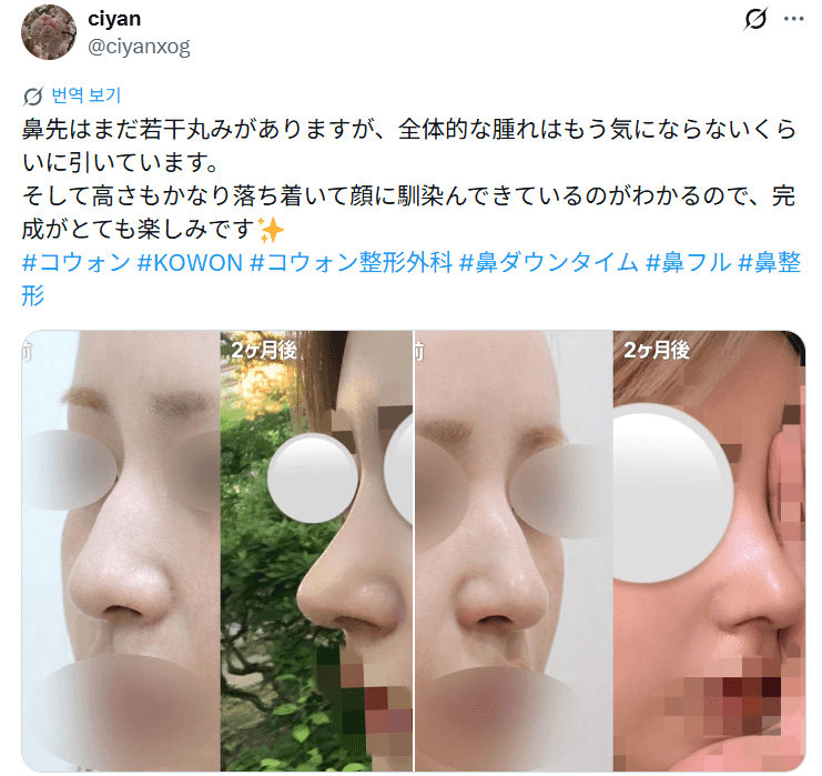 환자수술후기 — 「腫れもかなり引いて横顔のラインが綺麗に」鼻整形2週間
