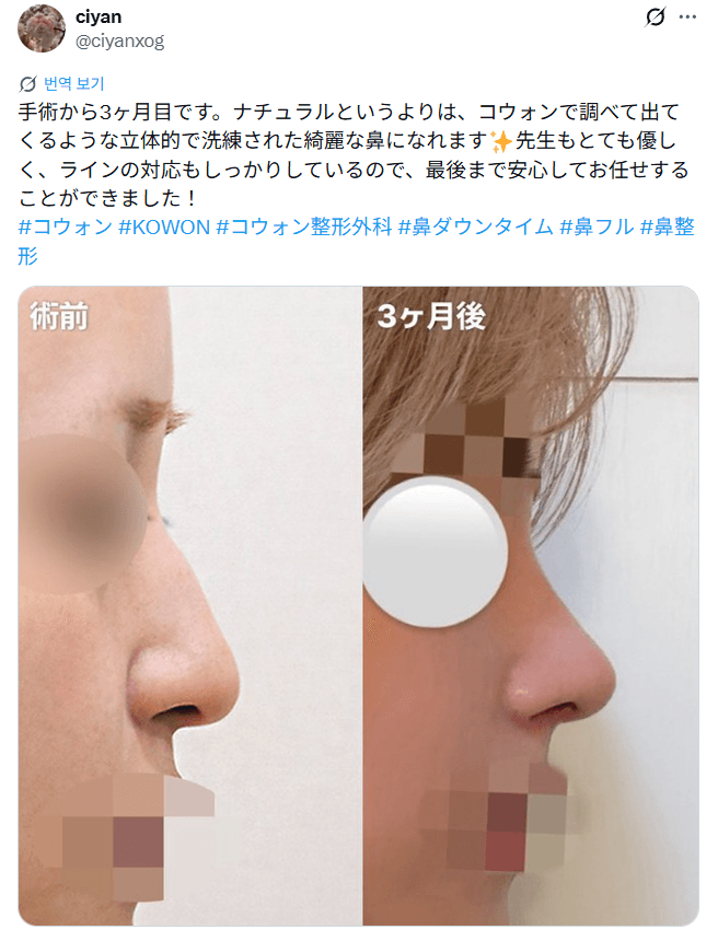 รีวิวหลังผ่าตัดของผู้ป่วย — 「先生もとても優しくラインの対応もしっかり」鼻整形3ヶ月