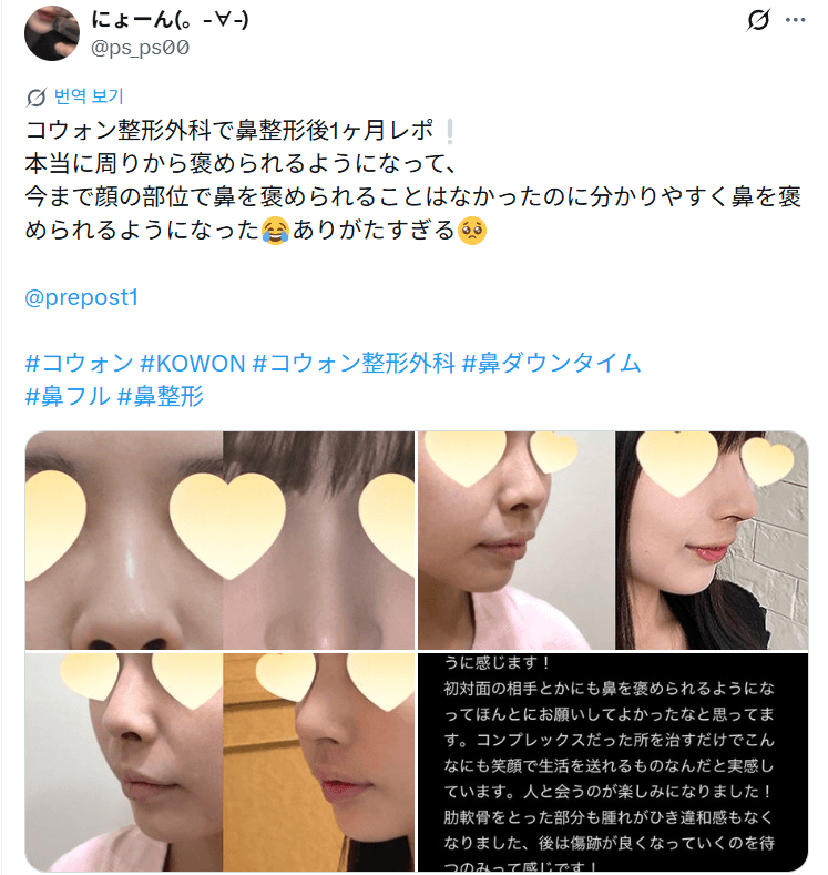 환자수술후기 — 「今まで顔の部位で鼻を褒められることはなかった」鼻整形1ヶ月