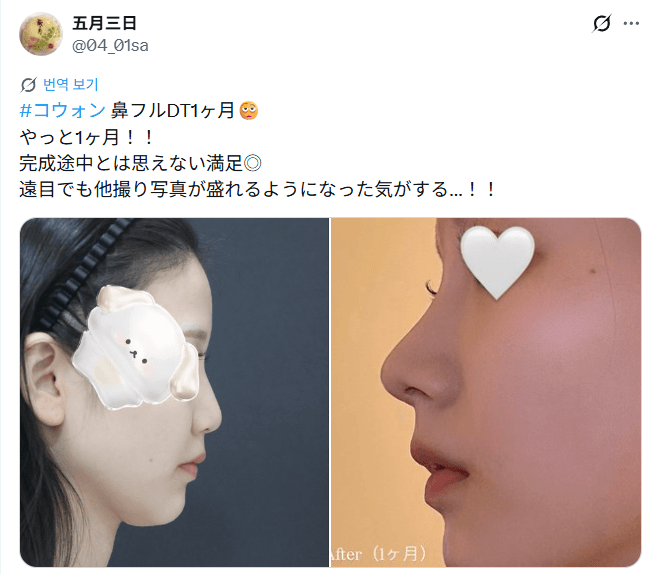 รีวิวหลังผ่าตัดของผู้ป่วย — 「完成途中とは思えない満足」鼻整形1ヶ月