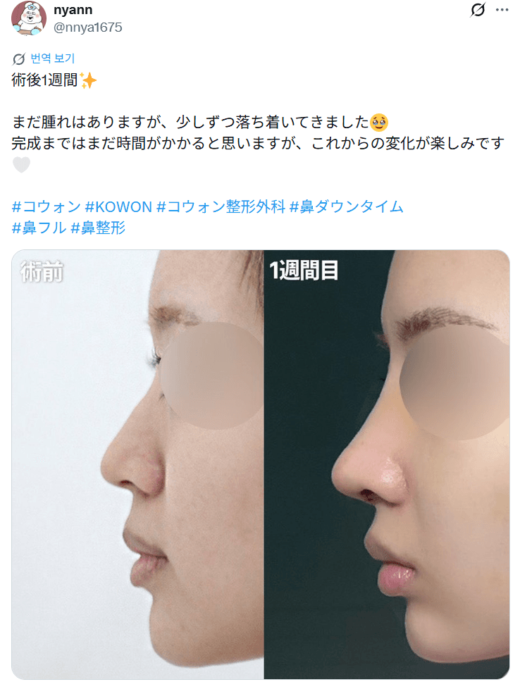 환자수술후기 — 「少しずつ落ち着いてきました」鼻整形1週間