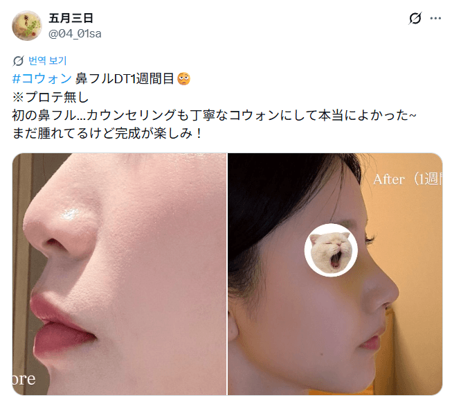 รีวิวหลังผ่าตัดของผู้ป่วย — 「初鼻フル、カウンセリングも丁寧で本当によかった」鼻整形1週間