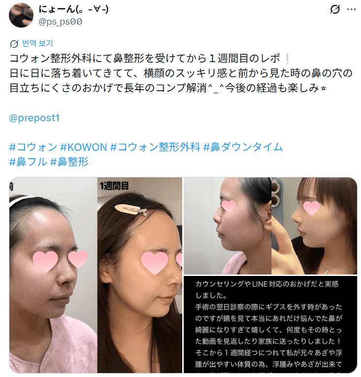 환자수술후기 — 「日に日に落ち着いて横顔のスッキリ感も」鼻整形1週間