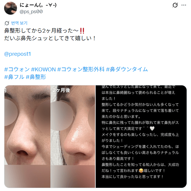 รีวิวหลังผ่าตัดของผู้ป่วย — 「だいぶ鼻先シュッとしてきて嬉しい」鼻整形2ヶ月