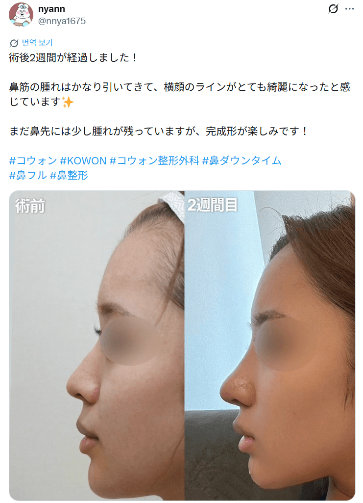 환자수술후기 — 「横顔のラインがとても綺麗になった」鼻整形2週間