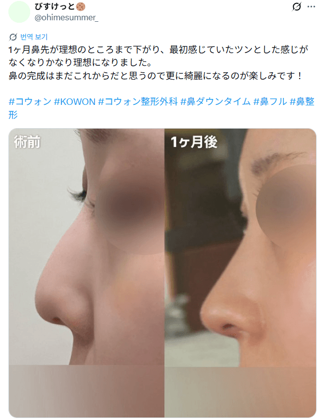 รีวิวหลังผ่าตัดของผู้ป่วย — 「鼻先が理想のところまで下がってきた」鼻整形1ヶ月