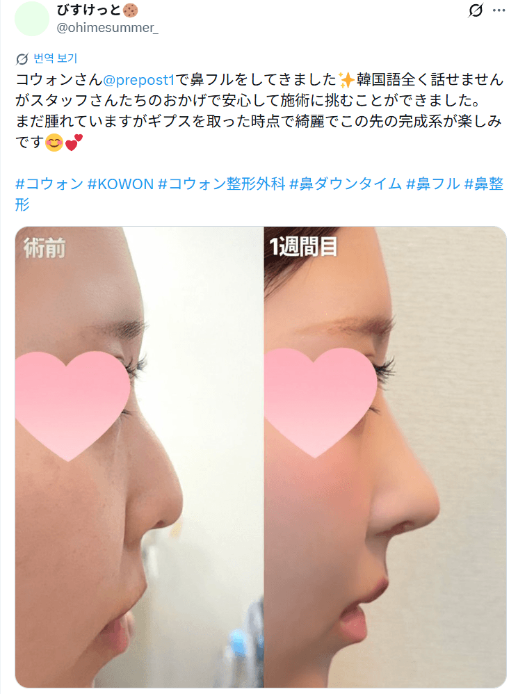 환자수술후기 — 「ギプスを取った時点で綺麗で完成が楽しみ」鼻整形1週間