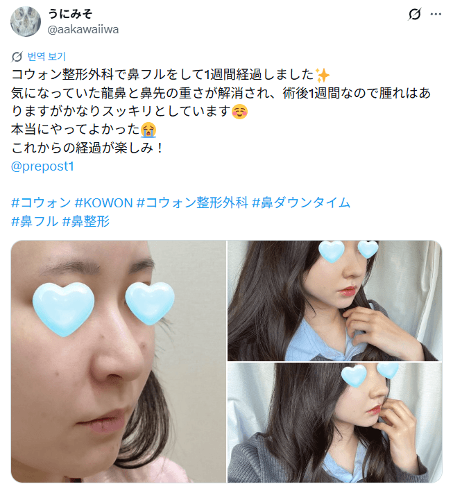 환자수술후기 — 「想像より腫れがなく鼻先が綺麗な形に」鼻整形1週間