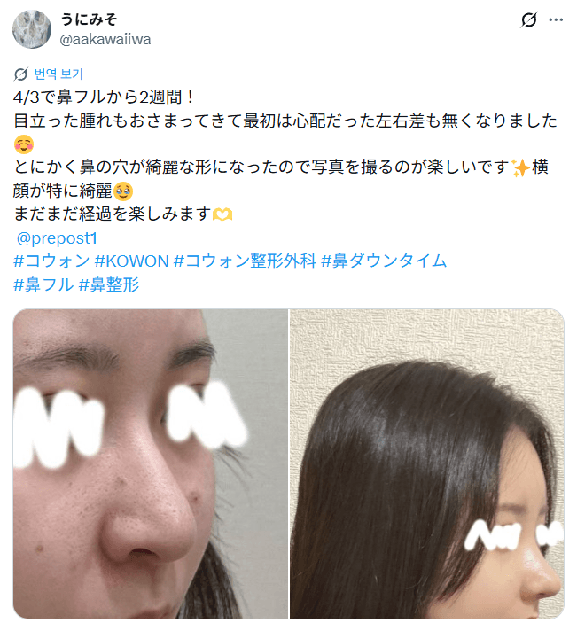환자수술후기 — 「鼻の穴が綺麗な形になって写真を撮るのが楽しい」鼻整形2週間
