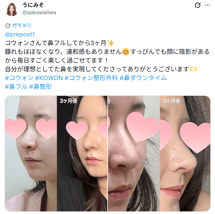 환자수술후기 — 「腫れもほぼなくなり違和感もありません」鼻整形3ヶ月
