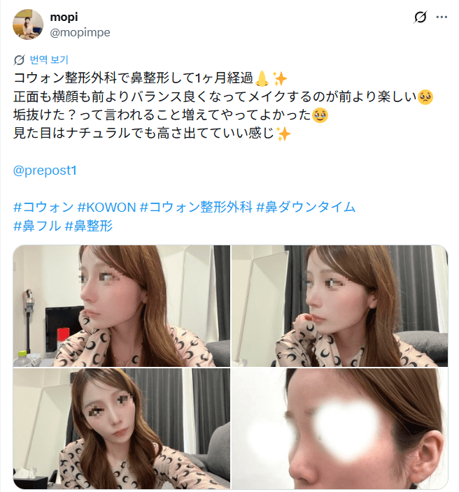 환자수술후기 — 「正面も横顔も前よりバランス良く」鼻整形1ヶ月