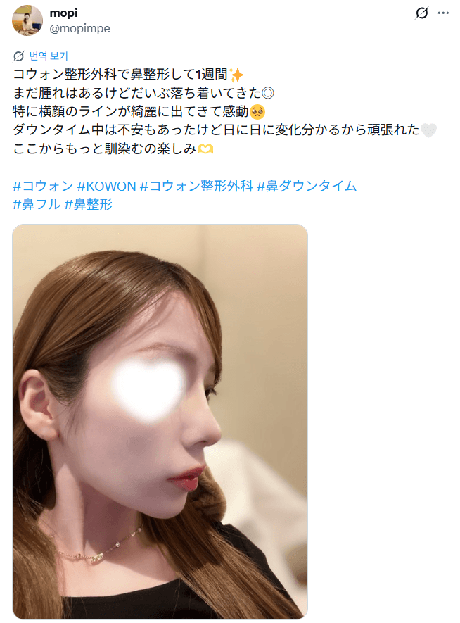 환자수술후기 — 「鼻フルから1週間、鼻の突出感が軽減」鼻整形1週間
