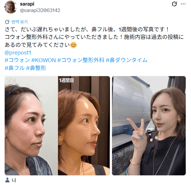 รีวิวหลังผ่าตัดของผู้ป่วย — 「鼻フル後、1週間後の写真です」鼻整形1週間