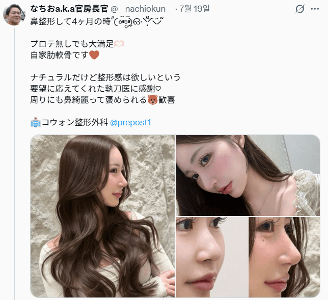 รีวิวหลังผ่าตัดของผู้ป่วย — 「プロテ無しでも大満足、自然な鼻です」鼻整形4ヶ月