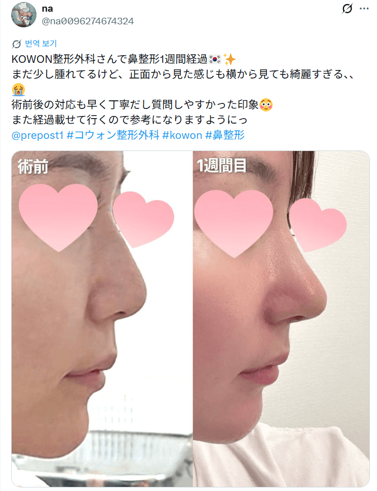 환자수술후기 — 「正面からも横から見ても綺麗すぎる」鼻整形1週間