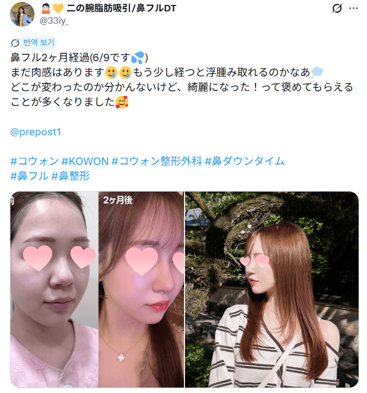 환자수술후기 — 「綺麗になった！って褒めてもらえることが多くなった」鼻整形2ヶ月