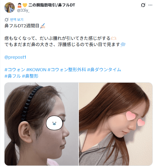 환자수술후기 — 「だいぶ腫れが引いてきた感じがする」鼻整形2週間