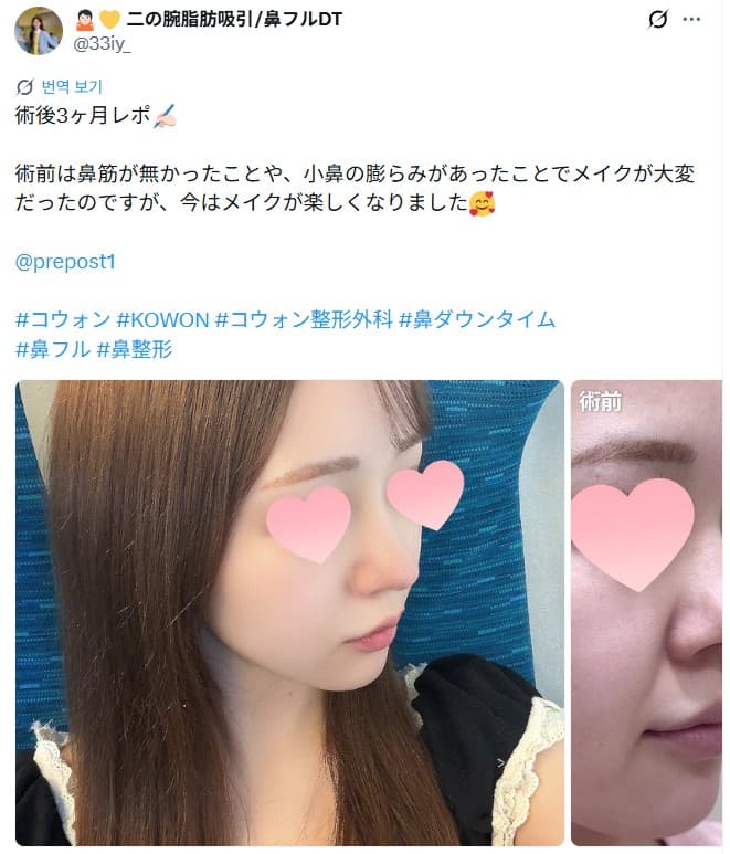 환자수술후기 — 術後3ヶ月。メイクが楽しくなった鼻フルの経過