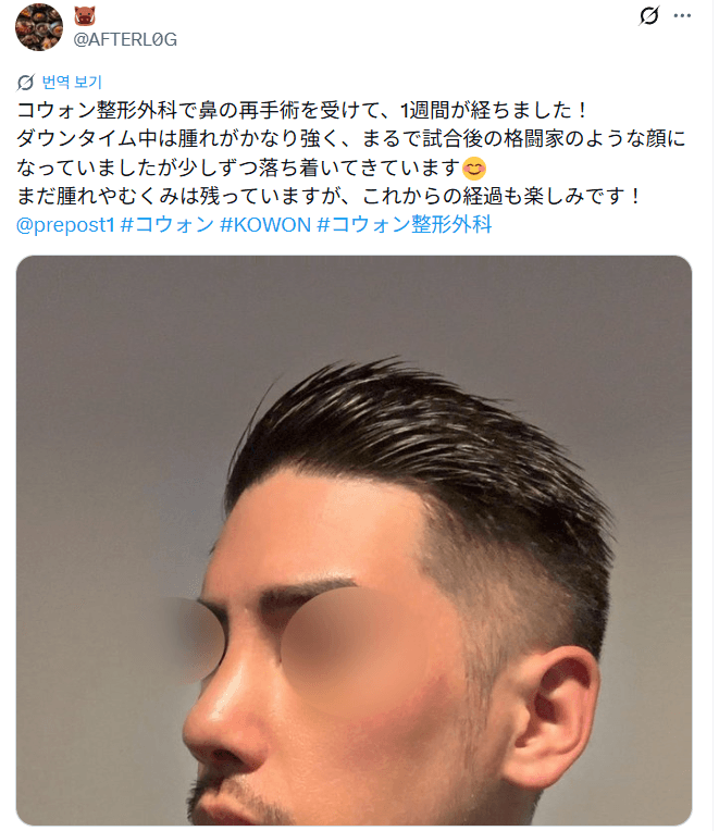 รีวิวหลังผ่าตัดของผู้ป่วย — 「まだ完成途中だけど横顔のラインがすごく綺麗」鼻整形1週間