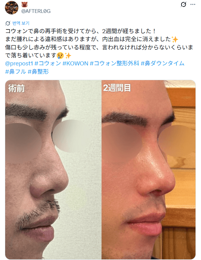 환자수술후기 — 「内出血は完全に消えました」鼻整形2週間