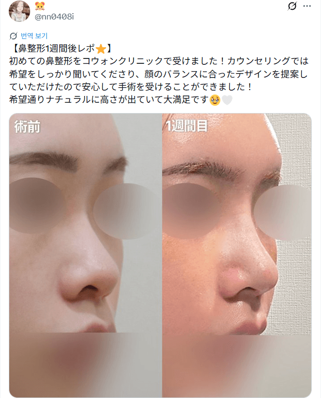 환자수술후기 — 「希望通りナチュラルに高さが出ていて大満足」鼻整形1週間