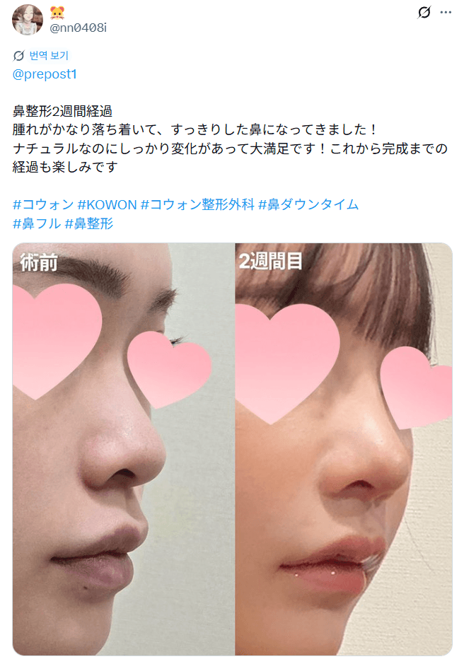 환자수술후기 — 「ナチュラルなのにしっかり変化があって大満足」鼻整形2週間