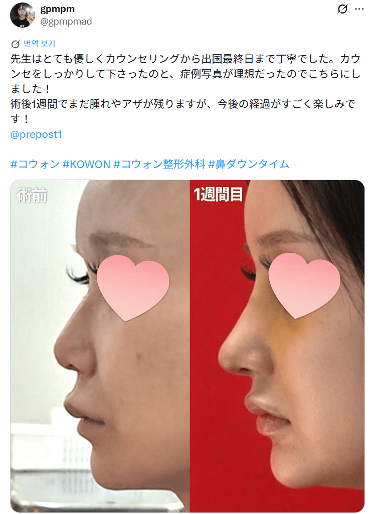 환자수술후기 — 「症例写真が理想だったのでこちらにしました」鼻整形1週間