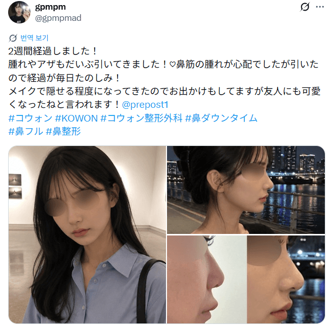 รีวิวหลังผ่าตัดของผู้ป่วย — 「メイクで隠せる程度になってお出かけも」鼻整形2週間