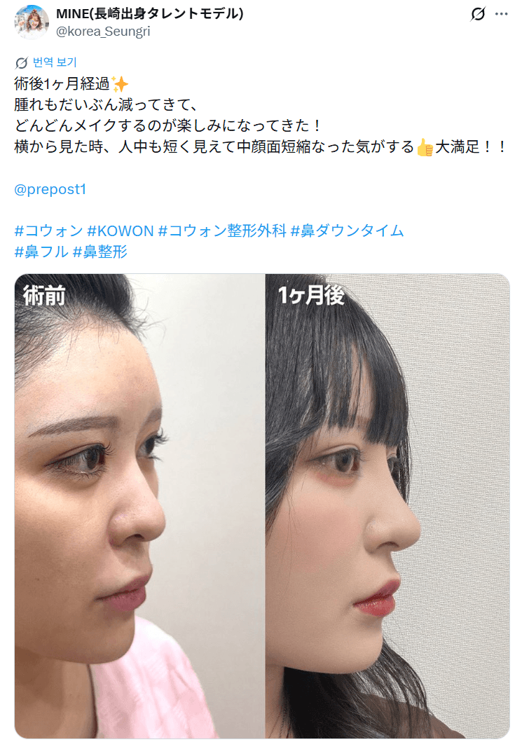 환자수술후기 — 「横から見た時、人中も短く見えて大満足」鼻整形1ヶ月