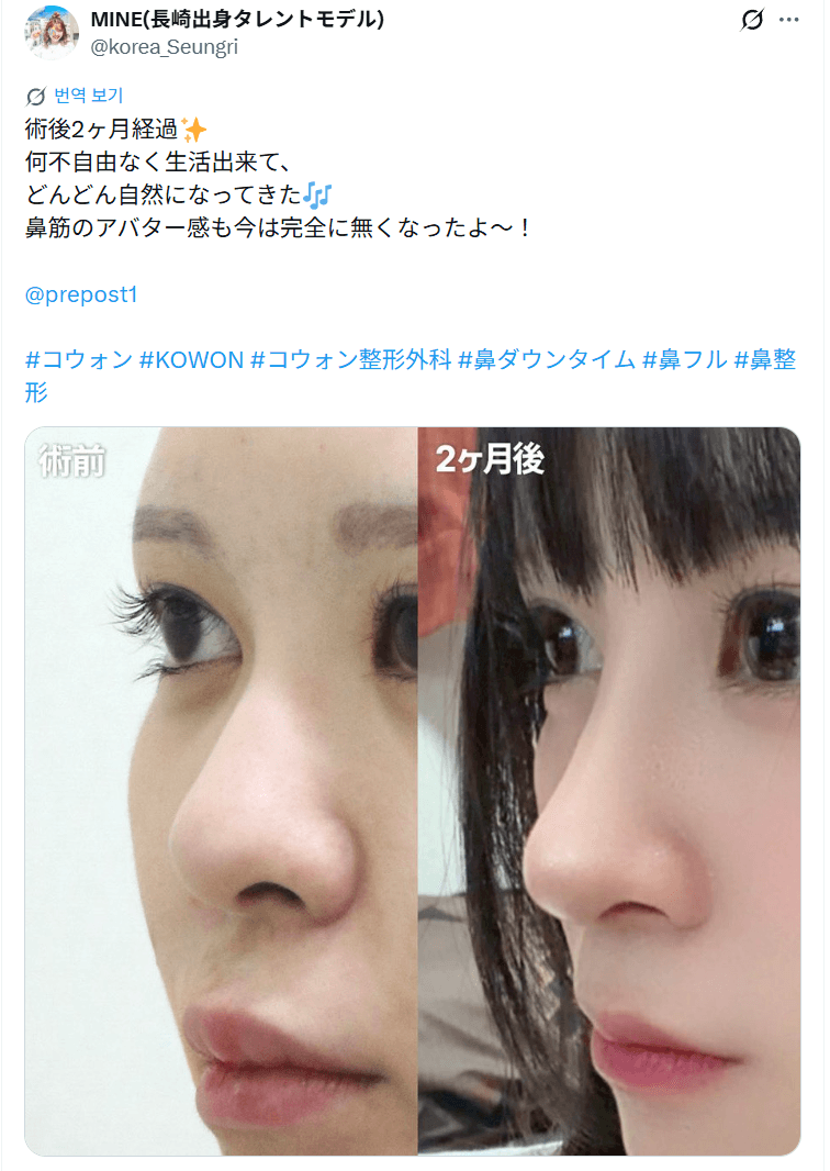 환자수술후기 — 「鼻筋のアバター感も今は完全に無くなった」鼻整形2ヶ月
