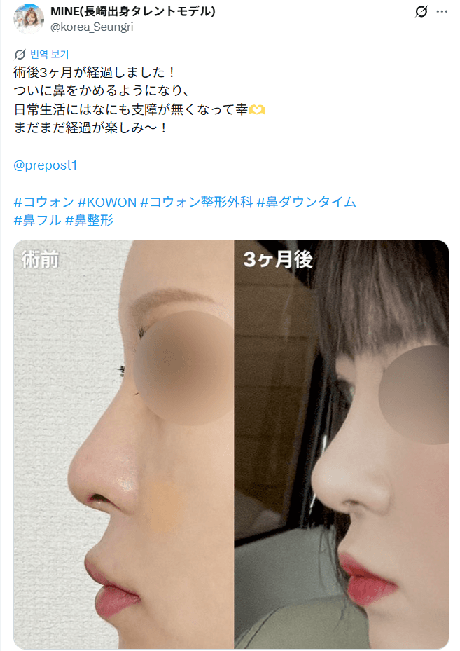 환자수술후기 — 「日常生活にはなにも支障が無くなって幸せ」鼻整形3週間