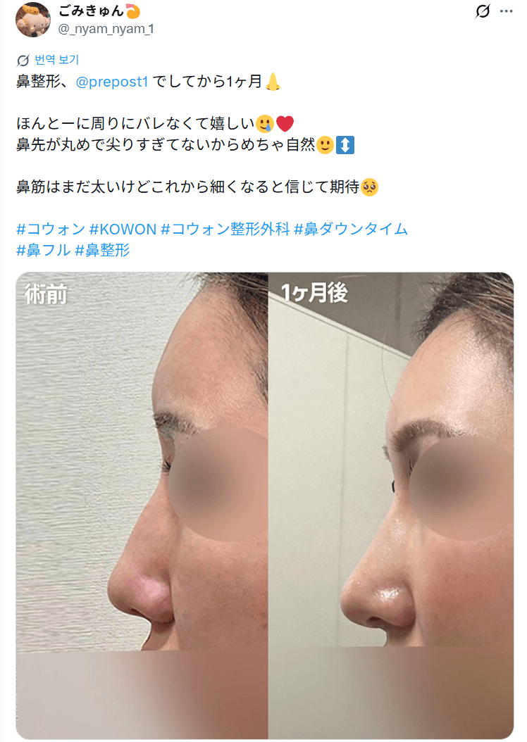 환자수술후기 — 「鼻先が丸めで尖りすぎてないからめちゃ自然」鼻整形1ヶ月