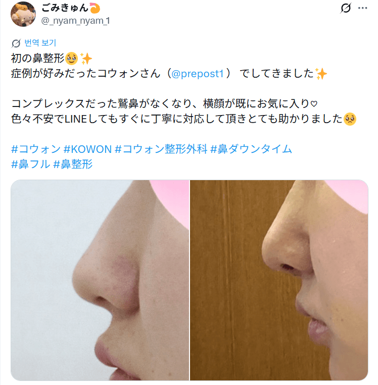 환자수술후기 — 「コンプレックスだった鷲鼻がなくなり横顔が気に入り」鼻整形1週間