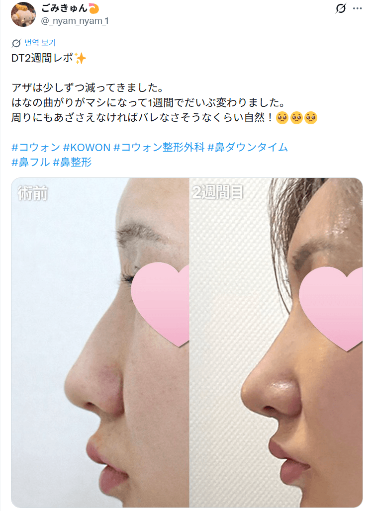 환자수술후기 — 「周りにも気づかれなければバレなさそうなくらい自然」鼻整形2週間