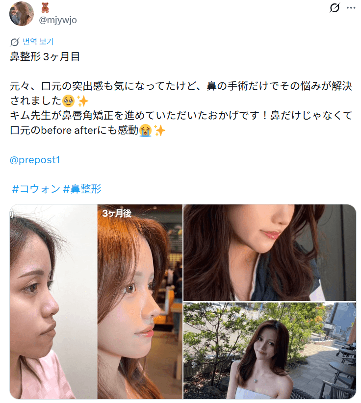 환자수술후기 — 「鼻だけじゃなく口元のbefore afterにも感動」鼻整形3ヶ月