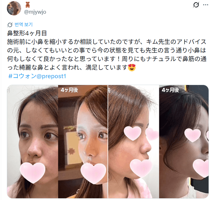 환자수술후기 — 「小鼻は何もしなくて良かったなと思っています」鼻整形4ヶ月