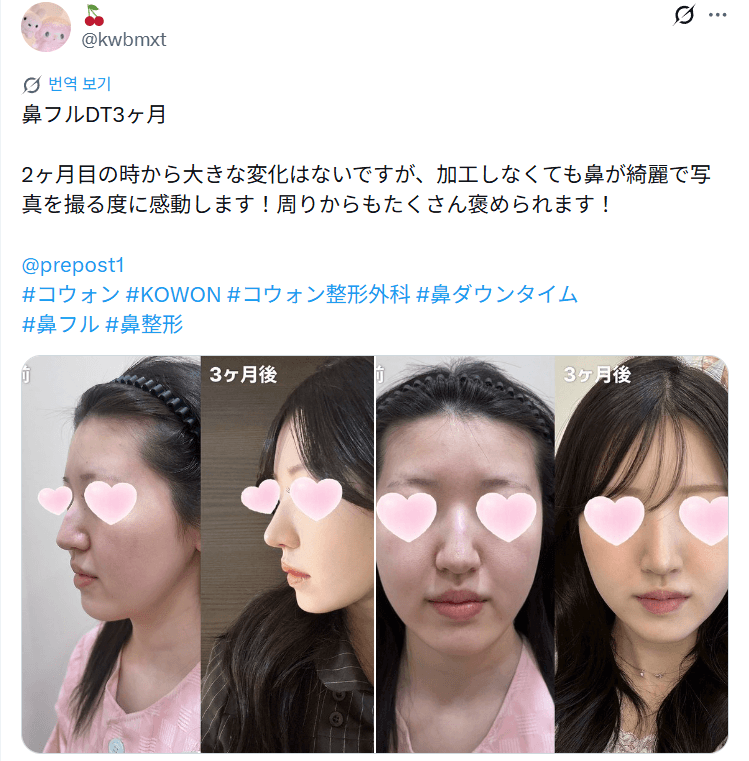 รีวิวหลังผ่าตัดของผู้ป่วย — 「加工しなくても鼻が綺麗で写真を撮る度に感動」鼻整形3ヶ月