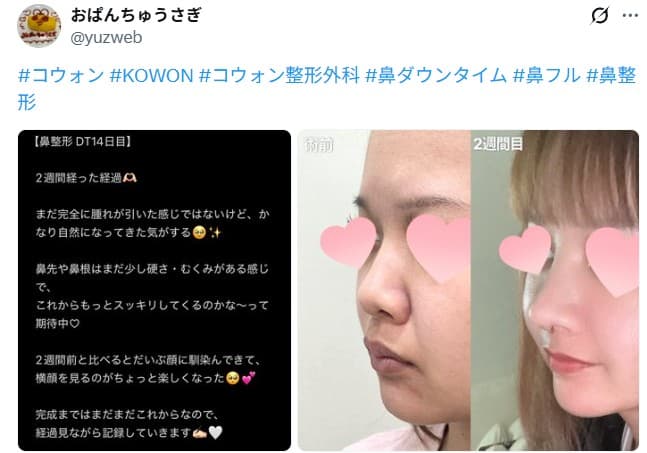 รีวิวหลังผ่าตัดของผู้ป่วย — 「横顔を見るのがちょっと楽しくなった」鼻整形2週間