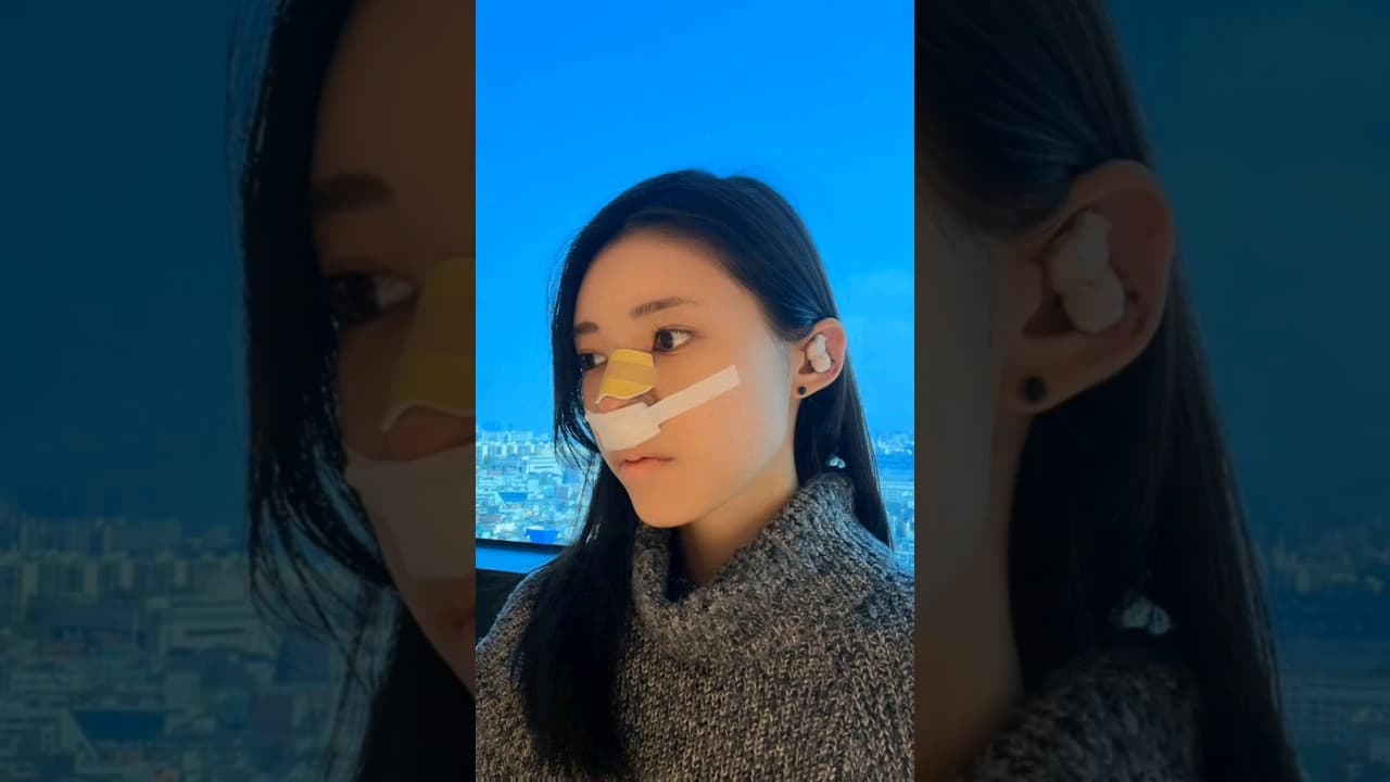 매부리코와 낮은 코끝이 신경쓰여서 코교정! #매부리코교정 #낮은코교정 #nosejob #鼻整形